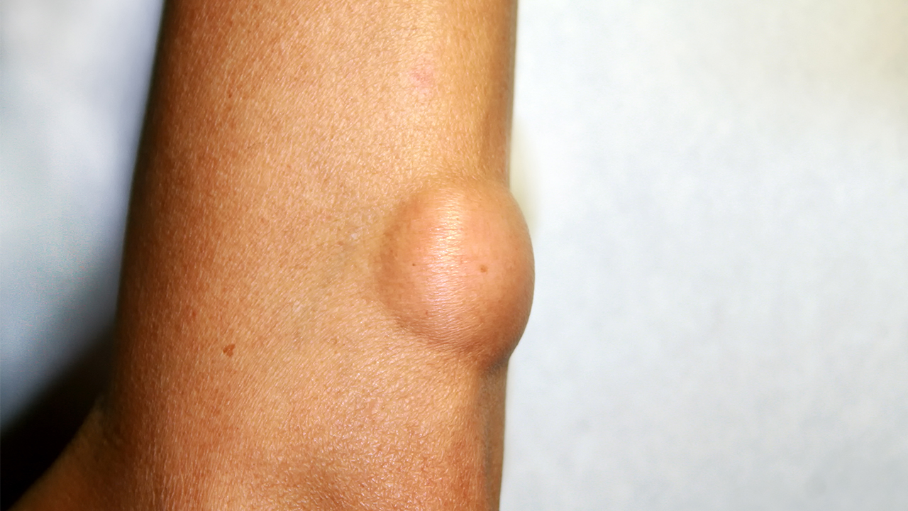 乳腺纖維腺瘤有什么癥狀 乳腺纖維腺瘤有哪些征兆