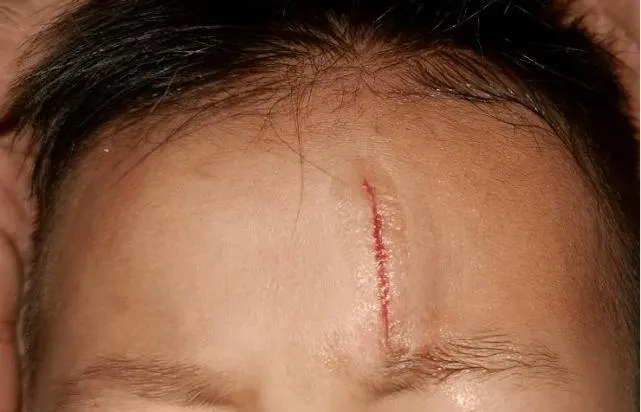 兒童疤痕凝膠，讓孩子即使有疤痕也擁有完美肌膚