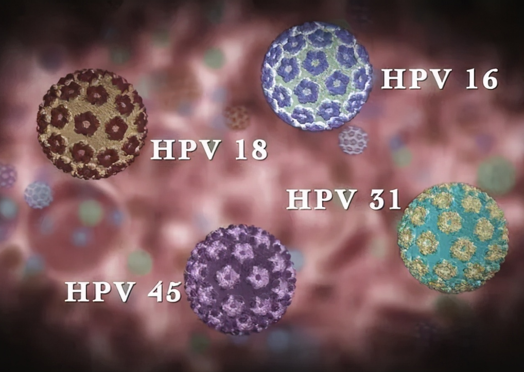 高危hpv感染是怎么回事？